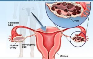 ovarian-cysts-s3-cysts-vivix-shaklee